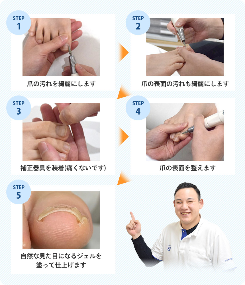 痛くない爪の補正